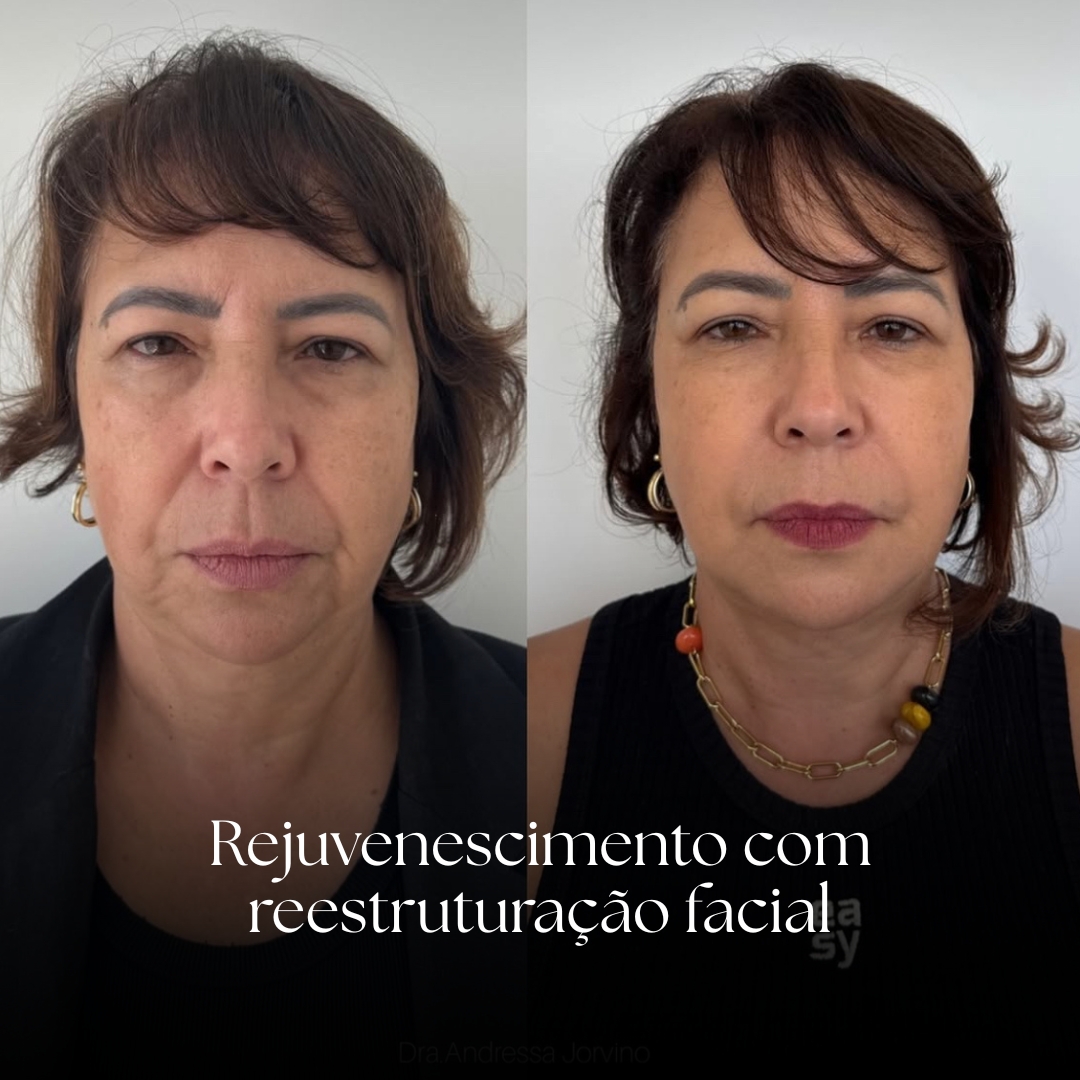 Rejuvenescimento c reestruturação facia (1)