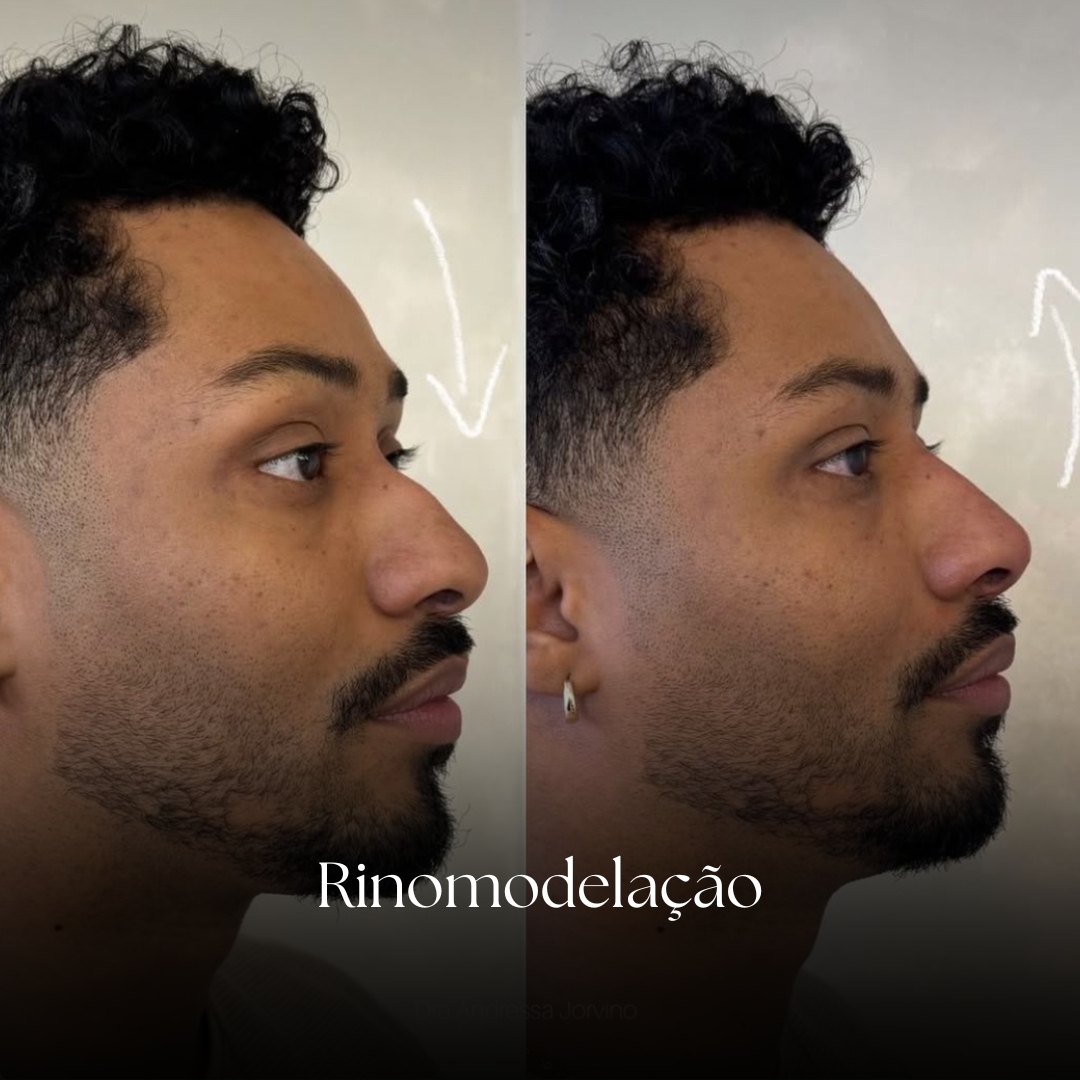 Rejuvenescimento c reestruturação facia